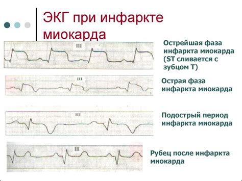 Экг при инфаркте миокарда: фото пленок и расшифровка признаков