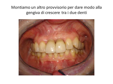 Problema A Entrambi Incisivi Superiori Dentista Roma