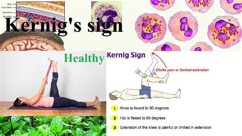 Kernig's sign - YouTube