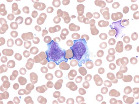 Acute Cytomegalovirus Infection Stock Photo Image Of Cytology