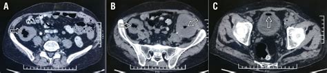 Bilateral Graft Emphysematous Pyelonephritis Bmj Case Reports