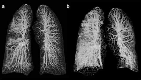 Así se ven los pulmones por el coronavirus DineroenImagen