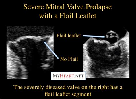 How Common Is Mitral Valve Prolapse