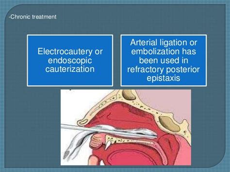 Epistaxis