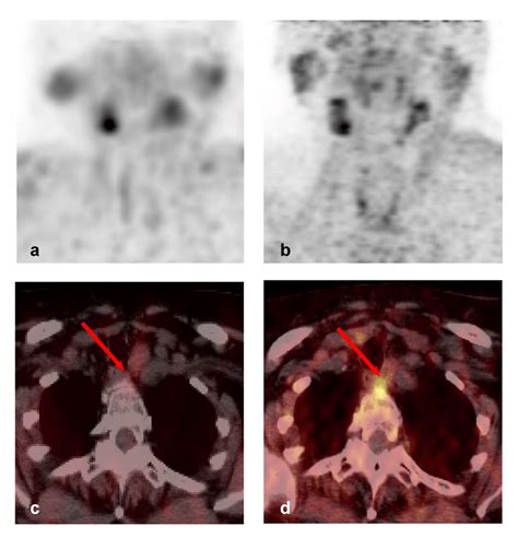 Mibi Spect Ct And Fch Pet Ct Images Of A Y Old Female Patient With