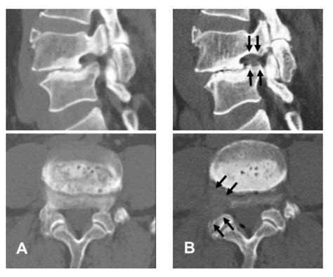 Diagnostics Free Full Text Full Endoscopic Lumbar Foraminotomy For Foraminal Stenosis In