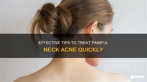 Effective Tips To Treat Painful Neck Acne Quickly Medshun