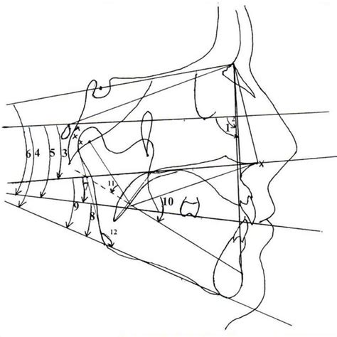 Ala Tragus Lines And Angles Clinical Case 1 Superior At Line 2
