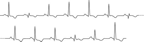 Eletrical Alternans The Ecg In Pericardial Effusion And Cardiac Tamponade The Cardiovascular