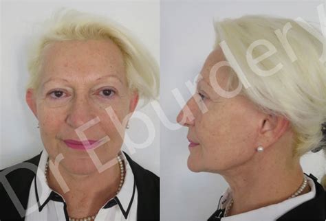 Photo Avant Apr S Lifting Cervico Facial Dr Eburdery Lyon