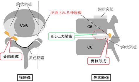 頚椎症性神経根症・脊髄症とは？症状は？mri画像と図を用いて解説！