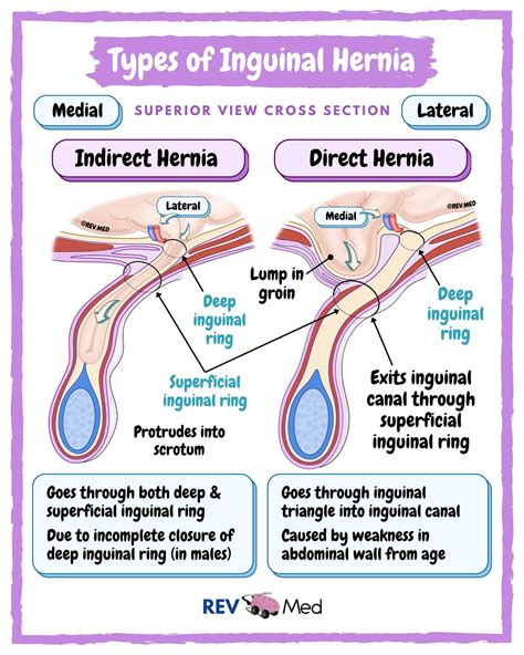 Indirect Vs Direct Inguinal Hernia