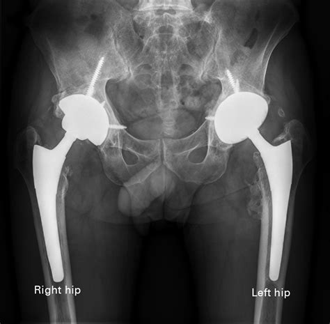 Isolated Revision Of An Acetabular Component To A Ceramic On Ceramic Bearing In Patients Under