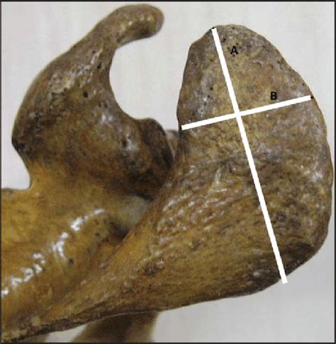 A-Length of the acromion B-Width of the acromion | Download Scientific ...