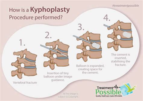 Kyphoplasty Surgery in India | Kyphoplasty Surgery Cost in India