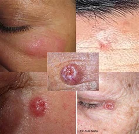 Dermatología Carcinoma Basocelular 1