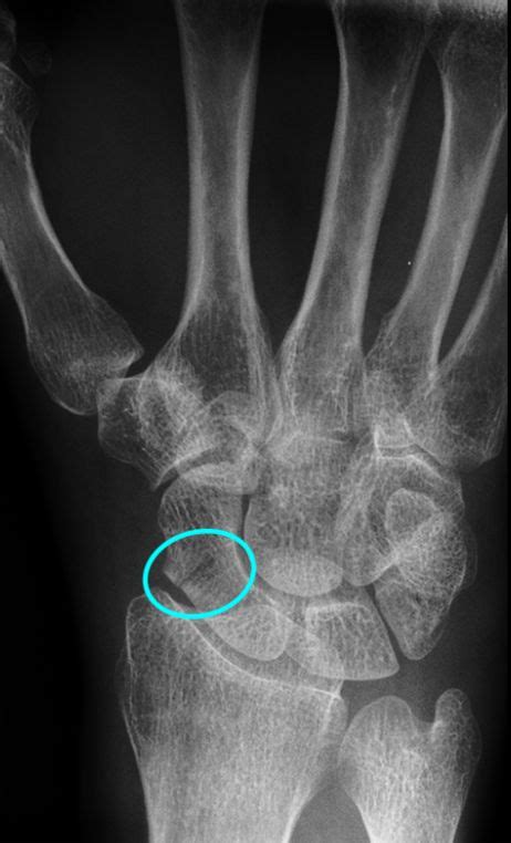 Radiografia De M O E Do Punho Saiba Mais Medway