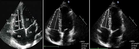 A Measurement Of Right Ventricle Rv Linear Dimensions From The