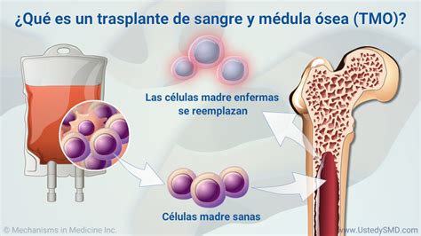 Presentación De Diapositivas Trasplante De Sangre Y Médula En Smd