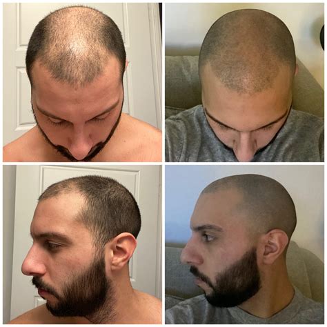 Balding Buzz Cut