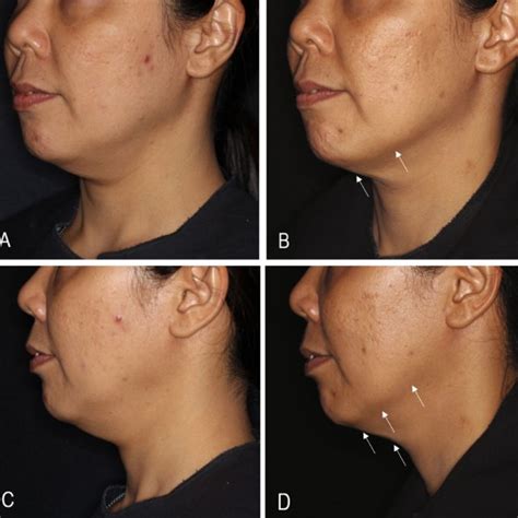 Clinical improvement on lower facial laxity after implantation of short ...