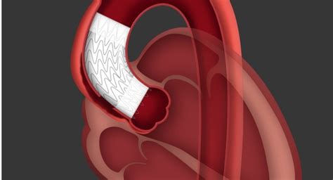 Gore Announces Successful Patient Implant Of Endovascular Stent Graft