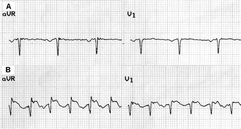 Exercise Induced St Segment Elevation In Leads Avr And V For The