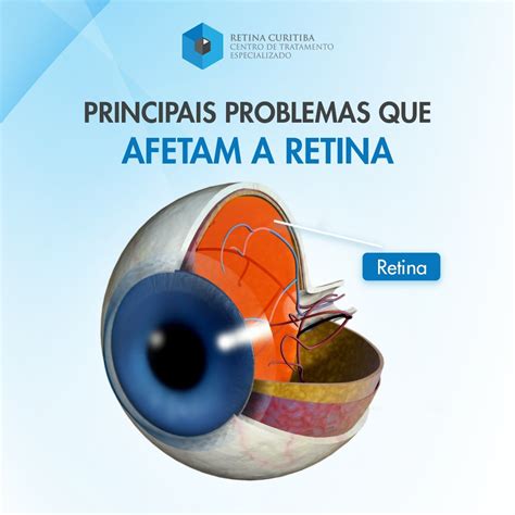 Tratamento de Doenças de Retina em Curitiba Conheça as principais