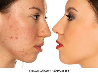 Acne Before And After Over 3 245 Royalty Free Licensable Stock Photos