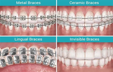 Types Of Braces Orthodontist Directory