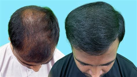 Best Hair Transplant Result In Kolkata Hair Transplant Clinic In