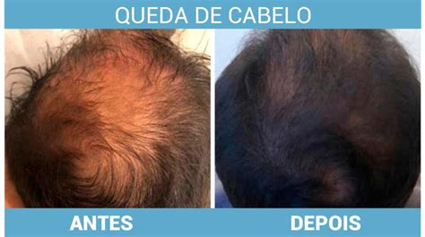 O Que Pode Ser Queda De Cabelo - Tratamento Para Queda De Cabelo - 3 Tipos, Causas, Preços E Resultados