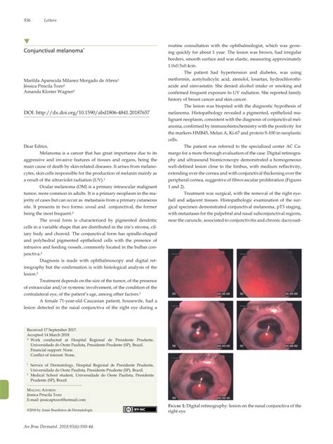 Pdf Conjunctival Melanoma