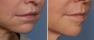 Female Custom Chin Implant Result Oblique View Dr Barry Eppley