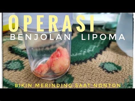 Proses Operasi Lipoma Tumor Jinak Benjolan Lemah Bawah Kulit Youtube