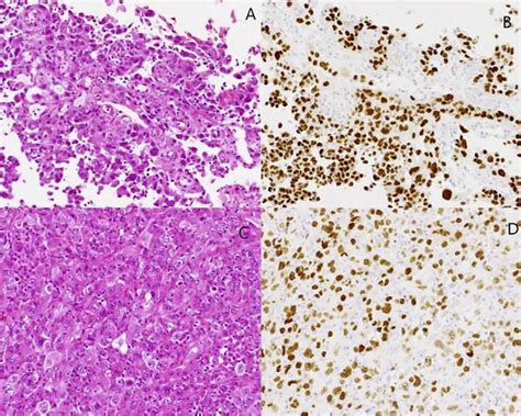 Hematoxylin And Eosin Stain Of Lung Tissue Showing Clusters Of