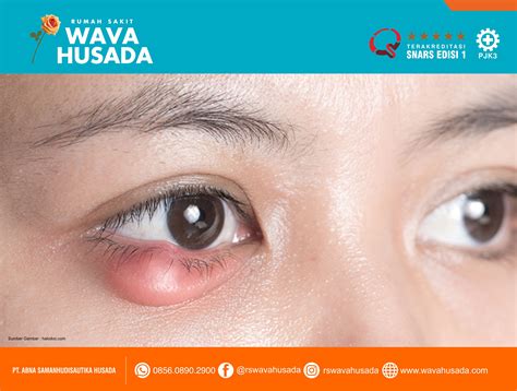 Infoker Mata Bintitan – Rumah Sakit