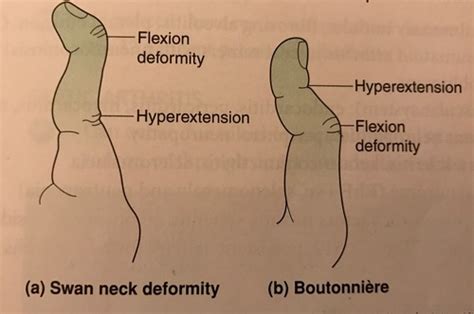 PANCE Ortho Rheum Flashcards Quizlet