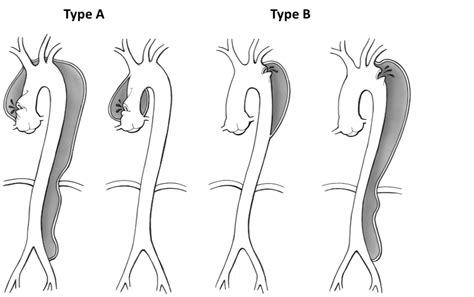 Aortic Dissection Rcemlearning