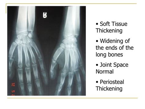 Primary hypertrophic osteoarthropathy (hpoa)