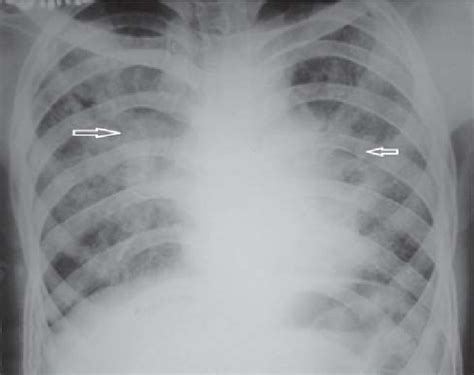 Chest Radiograph Postero Anterior View Of Patient 1 Table 4