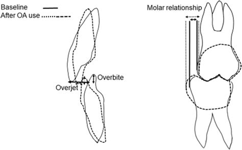 Overjet Vs Overbite