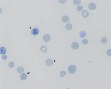 Reticulocytes Archives Eclinpath