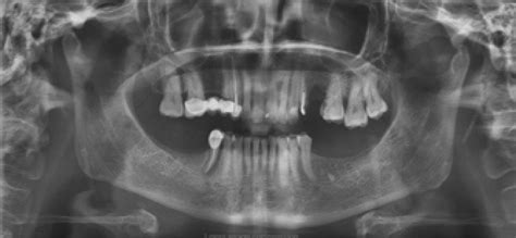 Potential For The Use Of Panoramic Radiography As A Diagnostic Aid In