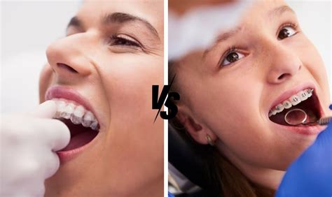 Invisalign Vs Traditional Braces Which Is The Best Option For You