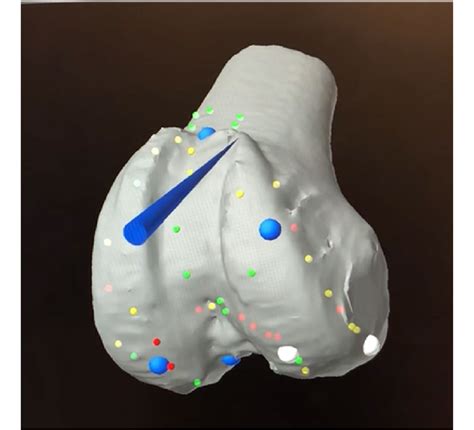 Femoral Bony Landmark Registration With A Total Knee Femoral Component
