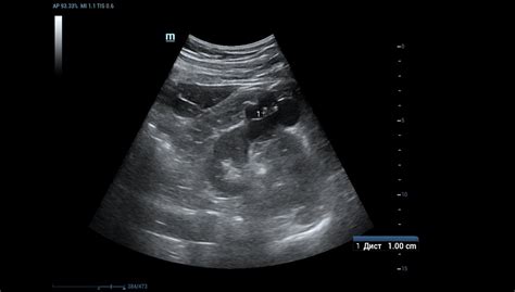 Ultrasound Journal 12 Multiparametric Ultrasound In Differentiating A