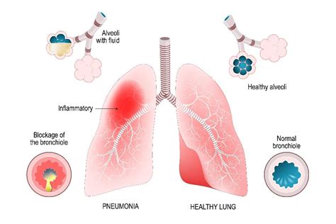 Pneumonia Singapore Interventional Pulmonology And Lung Clinic