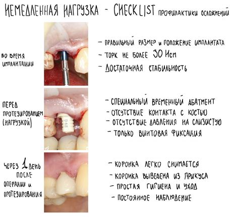 Периимплантит. Часть II: «Профилактика и лечение» — IMPLANT-IN.COM ...