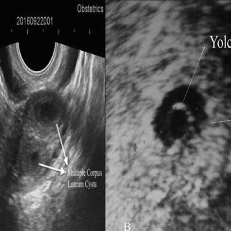Intrauterine pregnancy with embryo. | Download Scientific Diagram